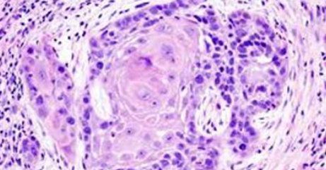 Cancerogeni: le esposizioni professionali e le direttive europee Cancerogeni: le esposizioni professionali e le direttive europee