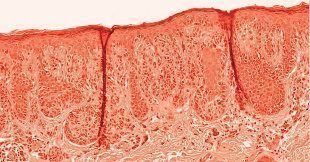 Inail: il melanoma cutaneo professionale da radiazioni solari Inail: il melanoma cutaneo professionale da radiazioni solari