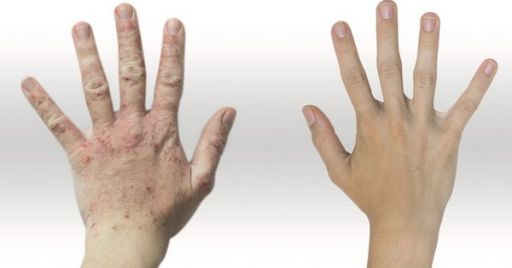 Protezione della pelle nei luoghi di lavoro: lesioni cutanee ed allergie Protezione della pelle nei luoghi di lavoro: lesioni cutanee ed allergie